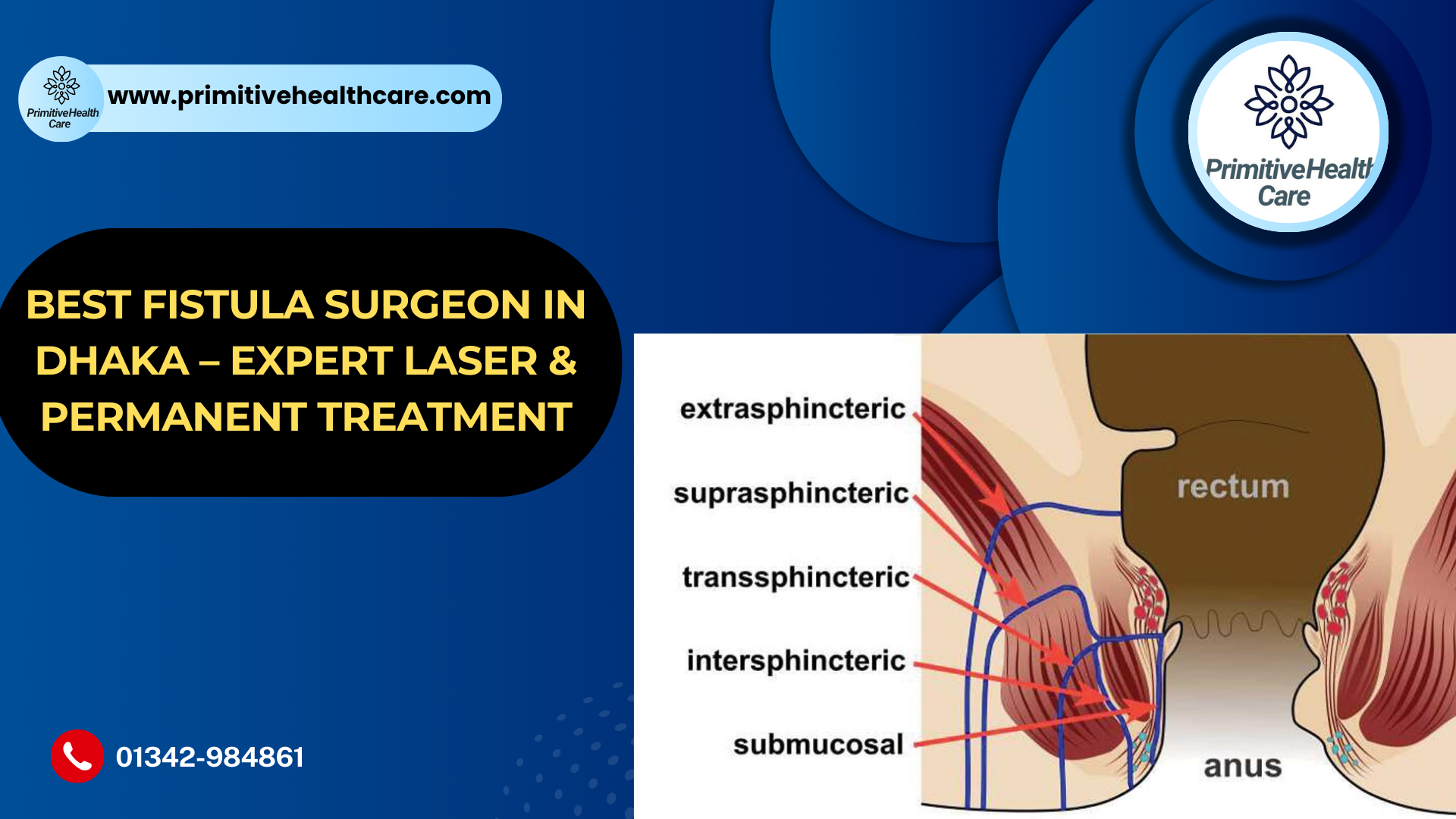 Best Fistula Surgeon in Dhaka | Laser Fistula Treatment Specialist
